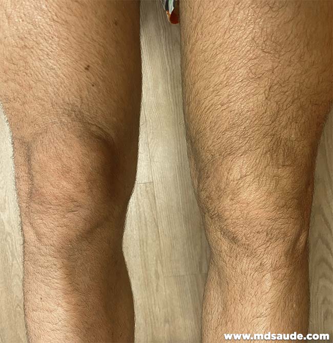 Lesão do menisco medial no joelho esquerdo