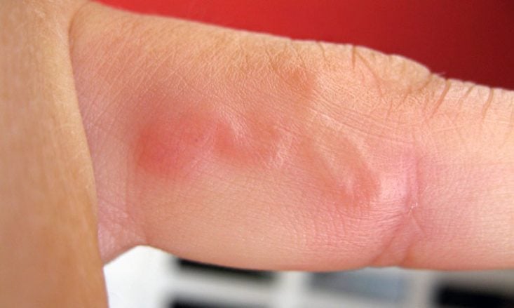 Larva migrans no dedo da mão