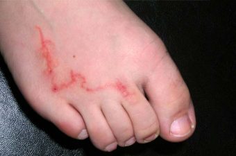 Picadura de pulga en humanos complicaciones