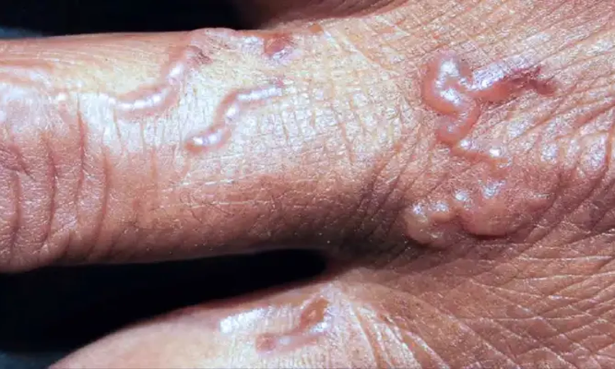 Fotos de larva migrans cutânea (bicho geográfico)