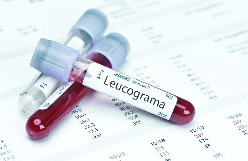 LEUCOCITOSE E NEUTROFILIA Principais Causas