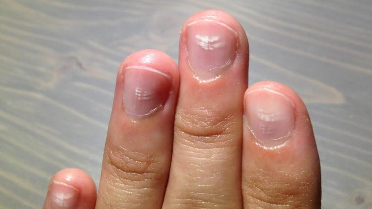 Leuconiquia: manchas brancas nas unhas