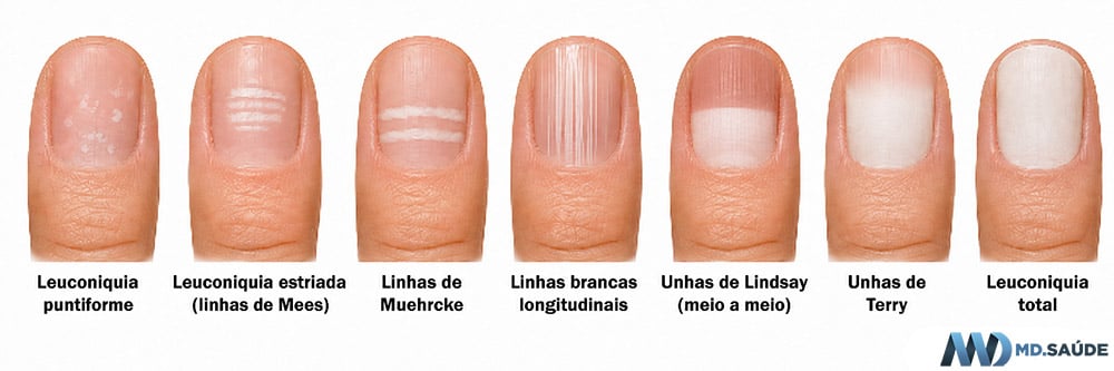 Tipos de leuconiquias