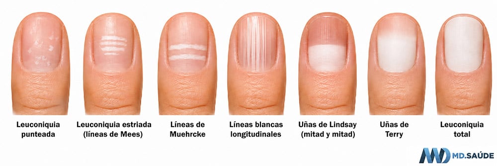 Tipos de leuconiquia