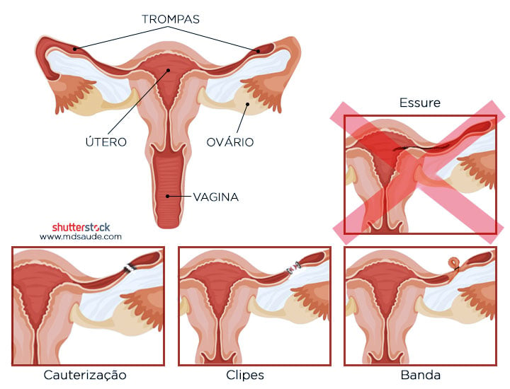 Obstrução das tubas uterinas: o que pode causar e como tratar? » Dr João  Dias