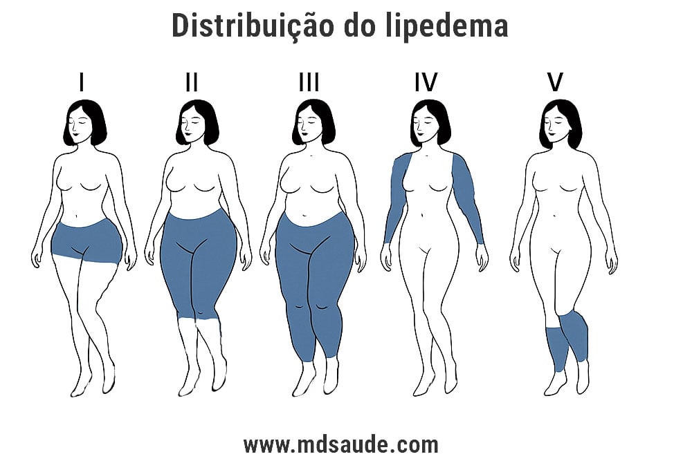 Tipos de distribuição do lipedema
