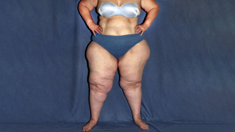 Lipedema
