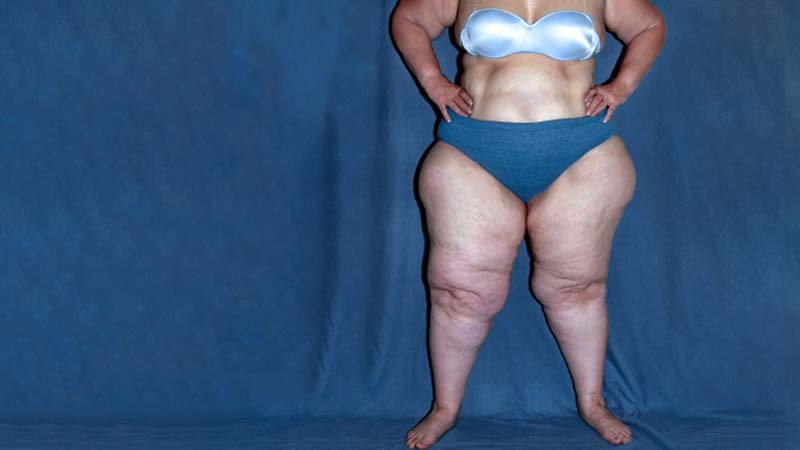 Lipedema