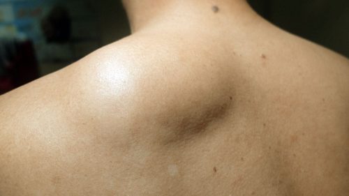 fotos-de-lipoma-en-el-brazo-espalda-cuello-y-cirug-a