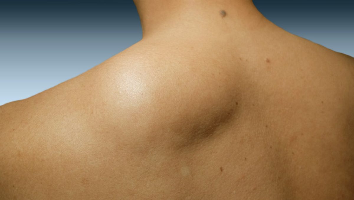 Lipoma o que é, causas e tratamento MD.Saúde