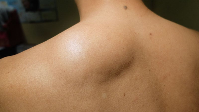 Apendicitis causas sintomas y tratamiento