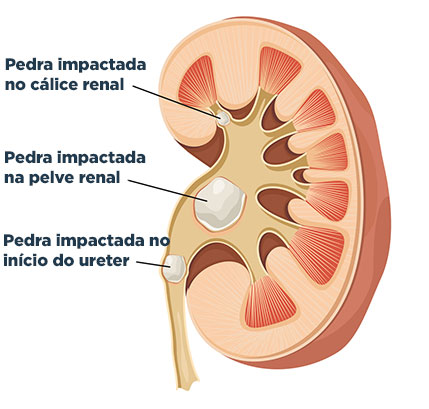 Diferentes pontos de impactação do cálculo renal