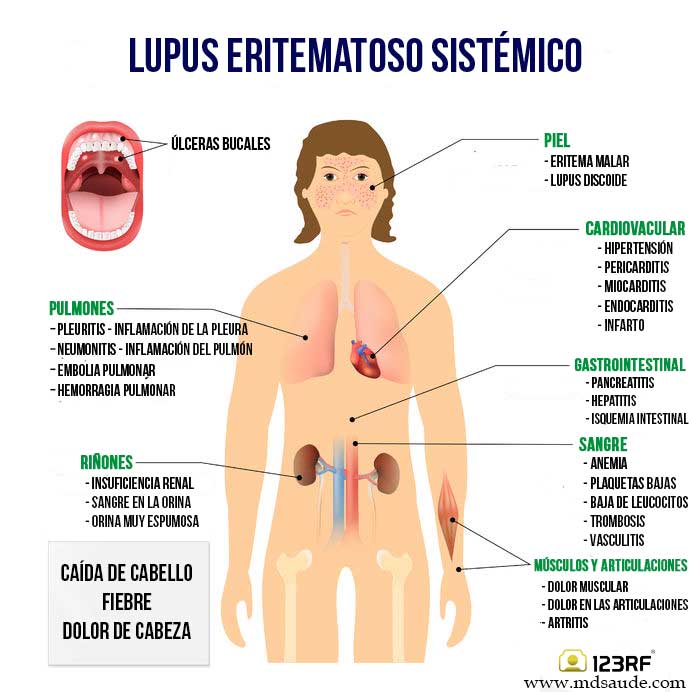 Síntomas del lupus