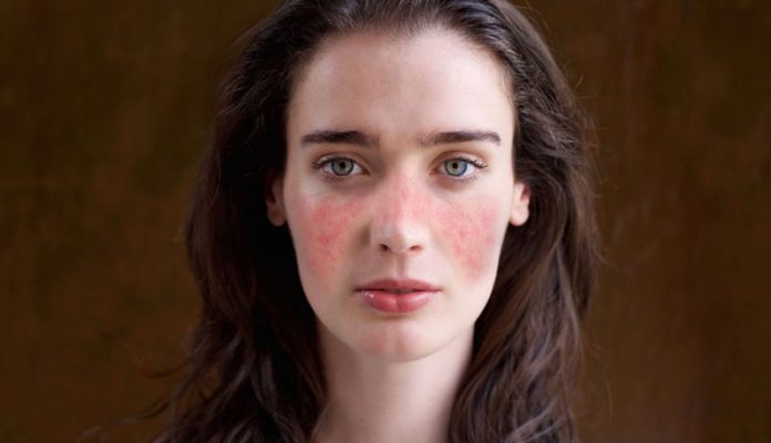 lupus-rash-malar Rash malar do lupus