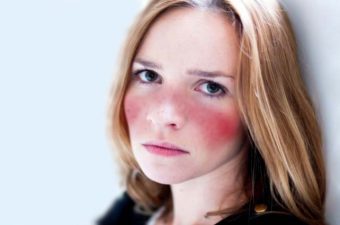 10 síntomas del lupus