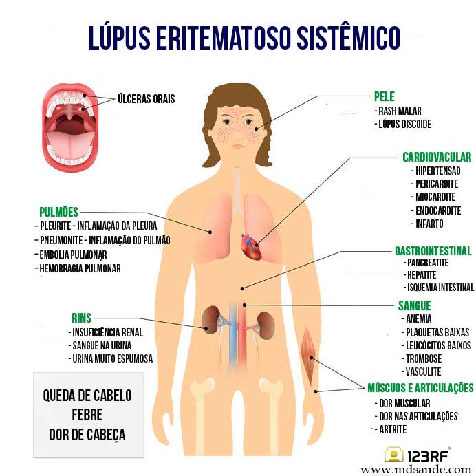 Sinais e sintoma do lúpus