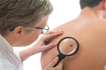 MELANOMA – O que é, fotos, sintomas e tratamento