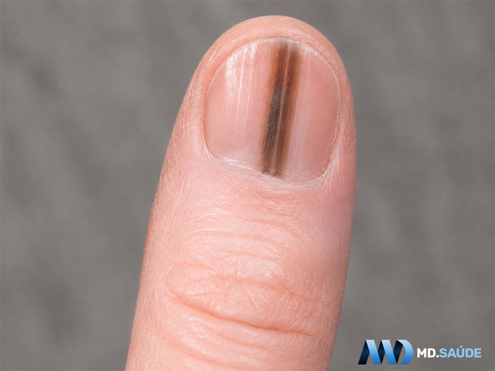 Melanoma subungueal