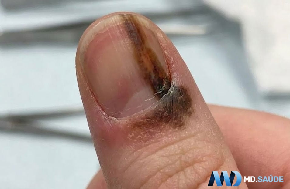 Melanoma subungueal atingindo a pele