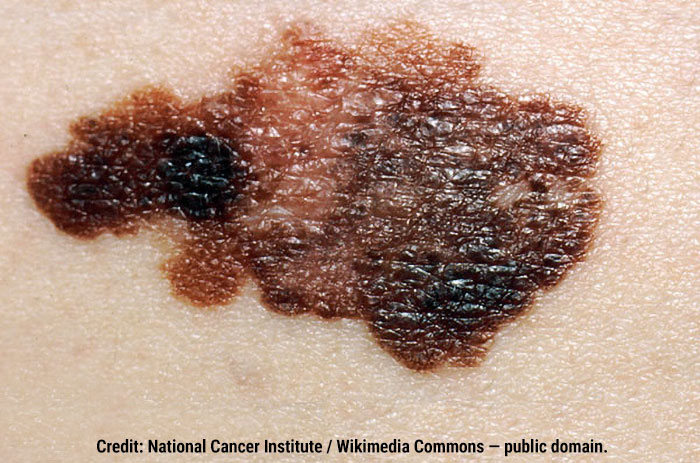 Asymmetry and color variation: melanoma.