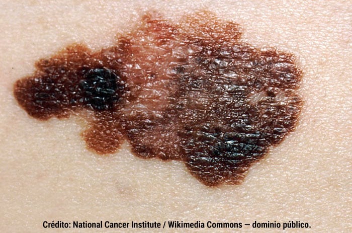 Asimetría y variación de color: melanoma.