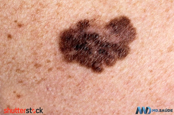 Asimetría, variación de color y lesión de más de 6 mm: melanoma.