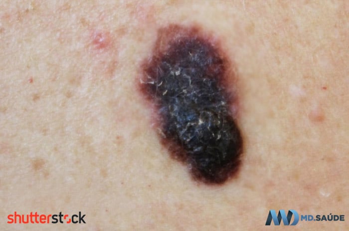 Asimetría, variación de color y bordes irregulares en el melanoma.