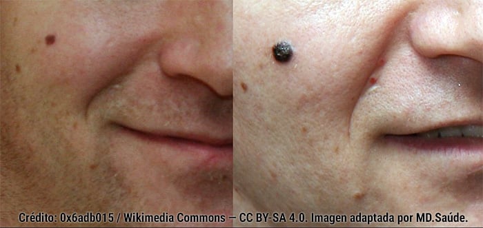 Lesión que cambia de tamaño y aspecto: melanoma.