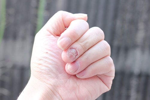 Onicomicose proximal no dedo da mão