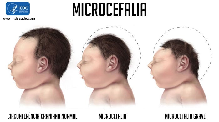 Comparación entre una cabeza de tamaño normal, una con microcefalia y otra con este padecimiento de forma severa