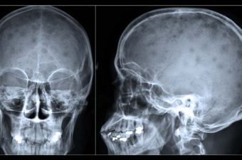 MIELOMA MÚLTIPLE – Síntomas y tratamiento