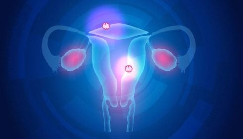 Mioma uterino (fibroma): qué es, síntomas y tratamiento