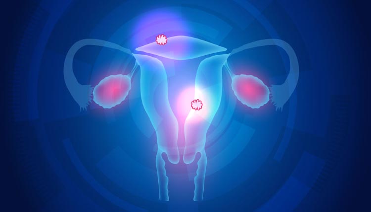 Mioma uterino (fibroma): qué es, síntomas y tratamiento