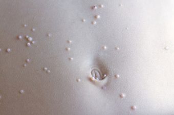MOLUSCO CONTAGIOSO – Sintomas, tratamento e fotos