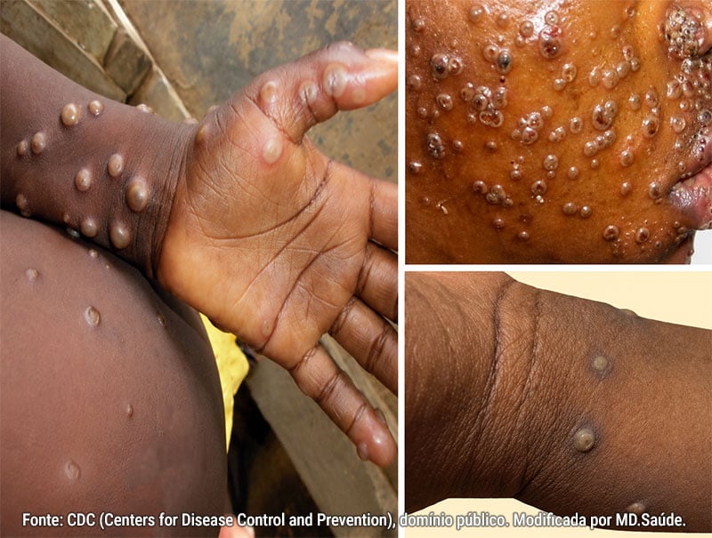 Exemplos de lesões cutâneas de mpox na mão, face e punho. As lesões são elevadas, bem delimitadas e algumas apresentam umbilicação central.