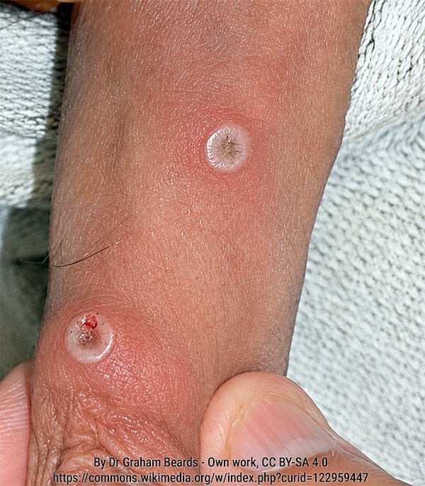 Lesões cutâneas de mpox na genitália masculina, com aspecto elevado, bordas bem definidas e depressão central característica (umbilicação).