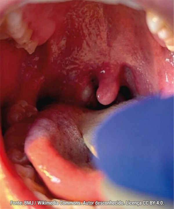 Lesão oral de mpox na amígdala direita, com aspecto pustuloso e exsudato.