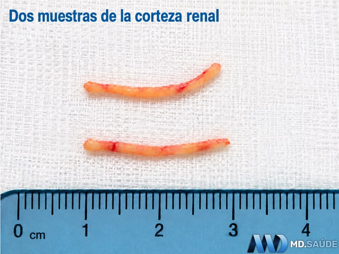 Dos muestras cilíndricas de tejido de la corteza renal obtenidas mediante biopsia, colocadas sobre una gasa blanca junto a una regla en centímetros.