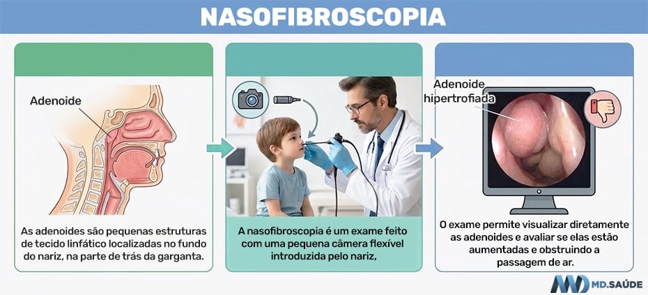 Infográfico explicando como é feito o diagnóstico da hipertrofia das adenoides com nasofibroscopia.