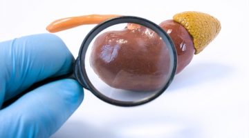 NEFROPATIA MEMBRANOSA – Causas, SIntomas e Tratamento