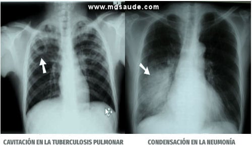 Neumonia y tuberculosis