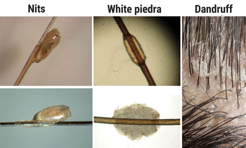 Differences between nits, white piedra, and dandruff