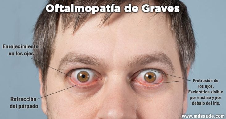 Oftalmopatía de Graves
