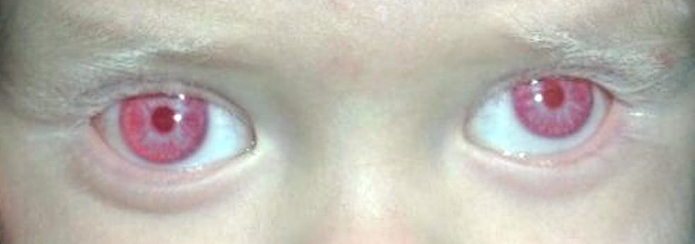 Cor dos olhos em albinos