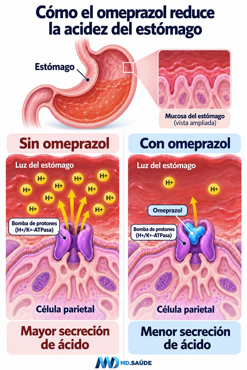 Ilustración médica que muestra cómo el omeprazol reduce la acidez del estómago al bloquear la bomba de protones de las células parietales, disminuyendo la secreción de iones H+ hacia la luz gástrica.