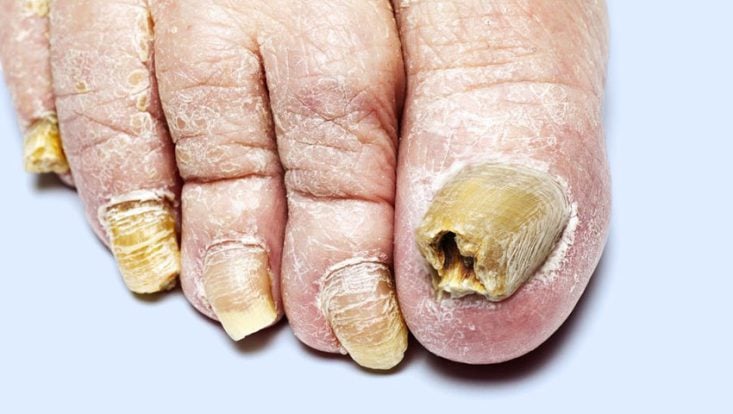 Onicomicosis: hongos en las uñas de los pies y de las manos