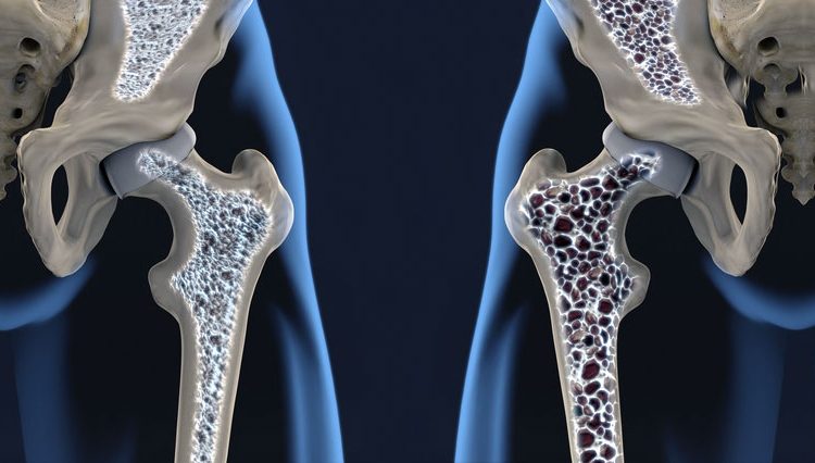 Osteoporose