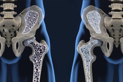 OSTEOPOROSIS – Síntomas, causas y tratamiento
