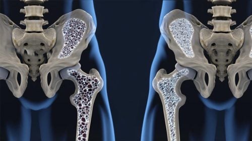 Osteoporosis: qué es, síntomas y tratamiento