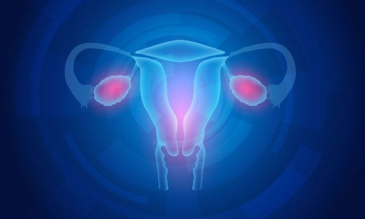 Síndrome de ovario poliquístico: síntomas y tratamiento